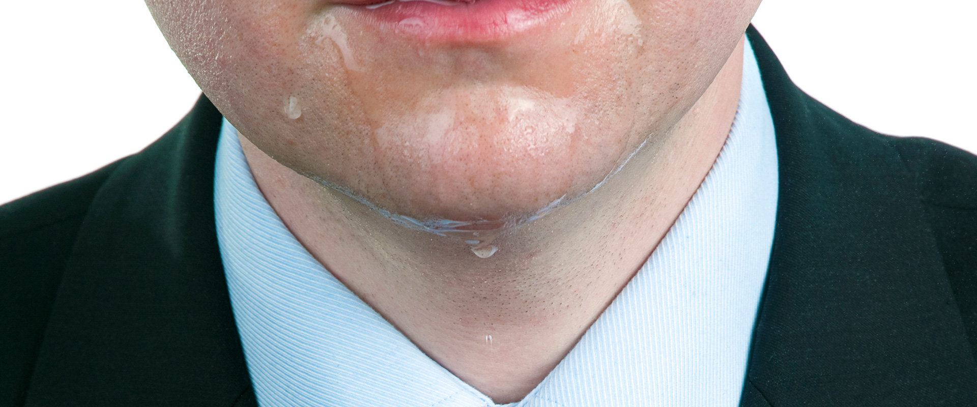 Hiperhidrosis localizada